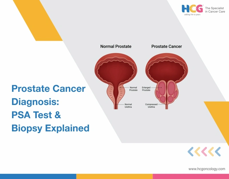 Prostate Cancer Diagnosis: PSA, MRI & Biopsy Tests