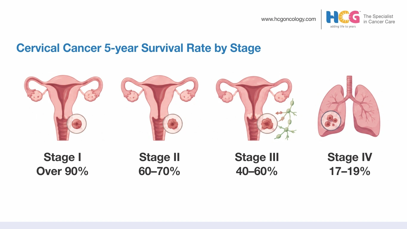 Illustration showing 5-year cervical cancer survival rates by stage, with Stage I over 90%, Stage II 60–70%, Stage III 30–50%, and Stage IV 17–19%.