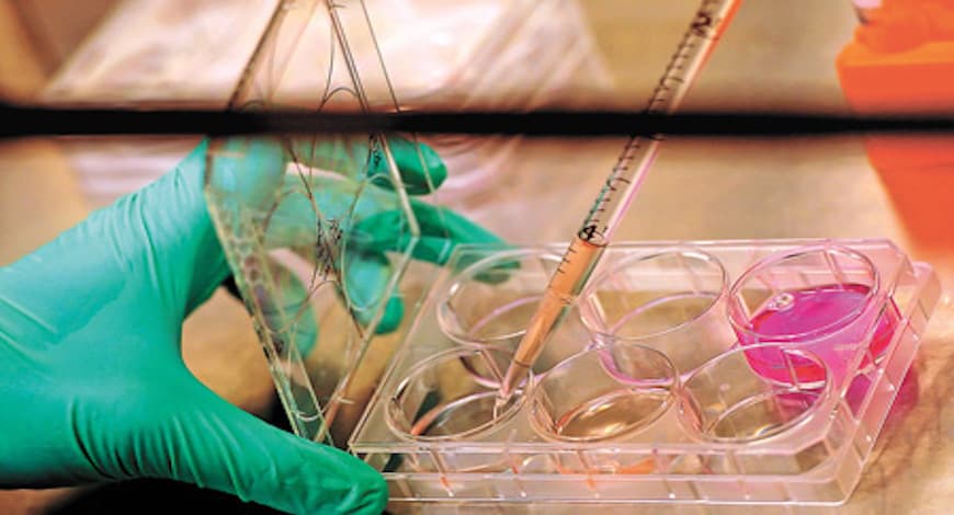 30-yr-old successfully treated for primary graft failure (bone marrow transplant) at HCG EKO Cancer Centre