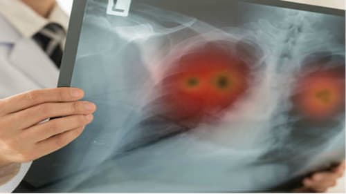 Lung Cancer Challenges In Pandemic Times