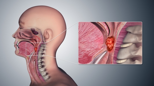 Facing pain while swallowing? Check for oropharyngeal cancer